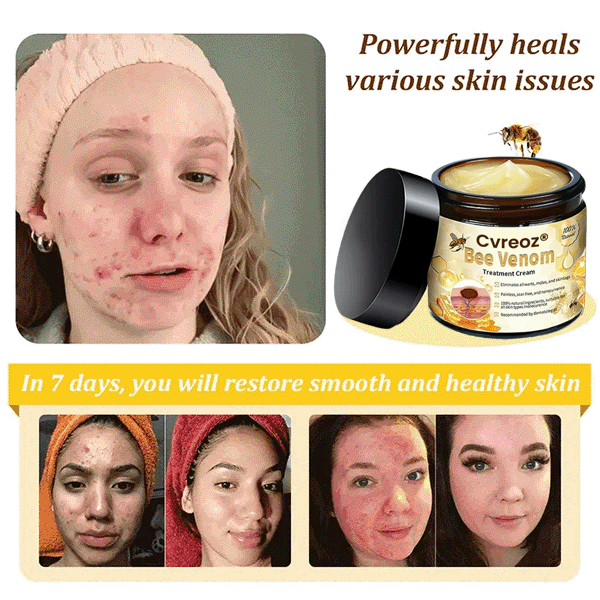 🔥FDA Approved⭐ WHO Approved🌍 Cvreoz® Bee Venom Skin Treatment Cream - Fast and effective⚡ targeting all skin issues✅ If ineffective, a refund is guaranteed💯