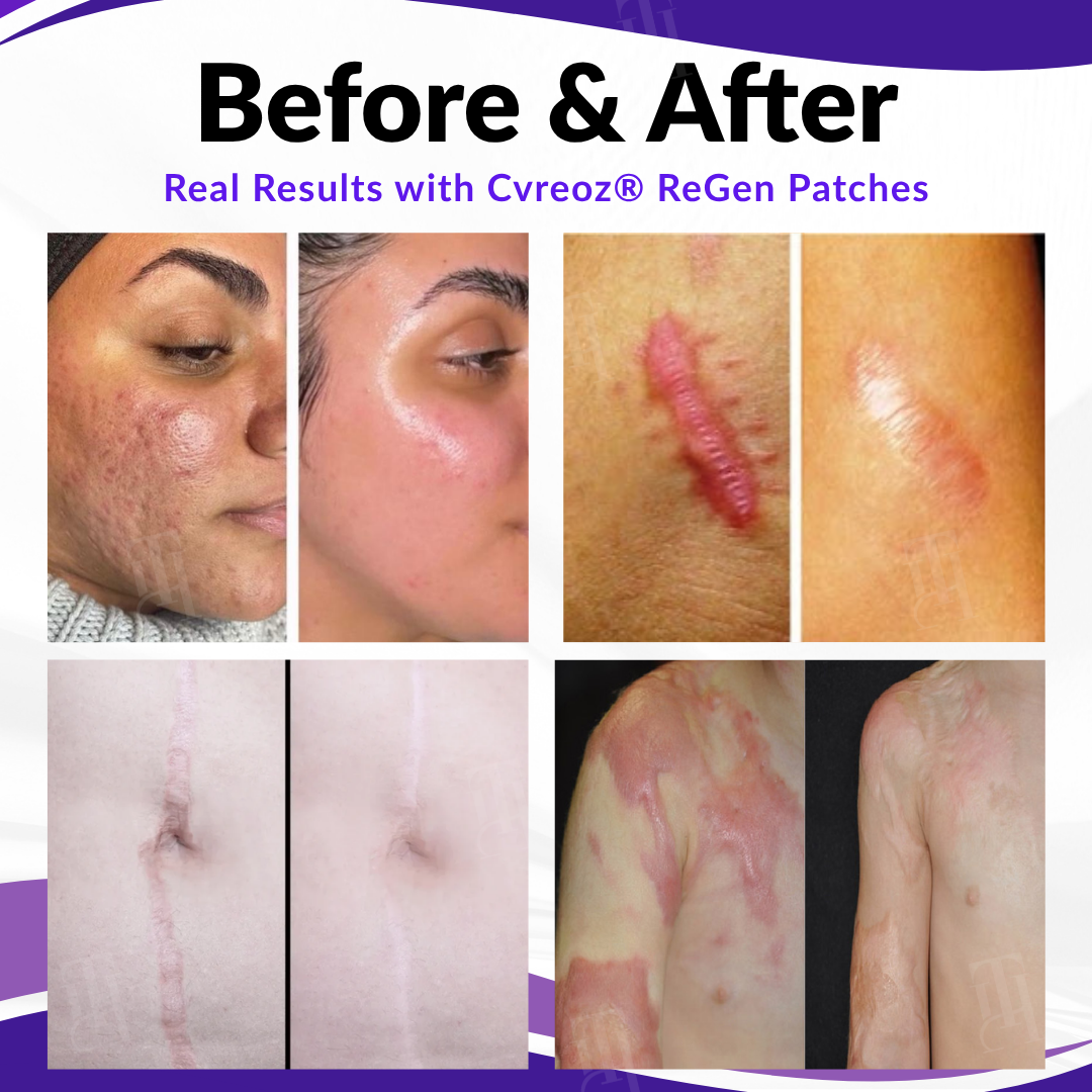 Official Store: Cvreoz® ReGen Microneedles Pro Patches with Hyaluronic Acid Nano-Heal Treatment for new and old scars, reduction of surgical scars, stretch marks, keloids, acne, burns, warts, dermatomas, and varicose veins.