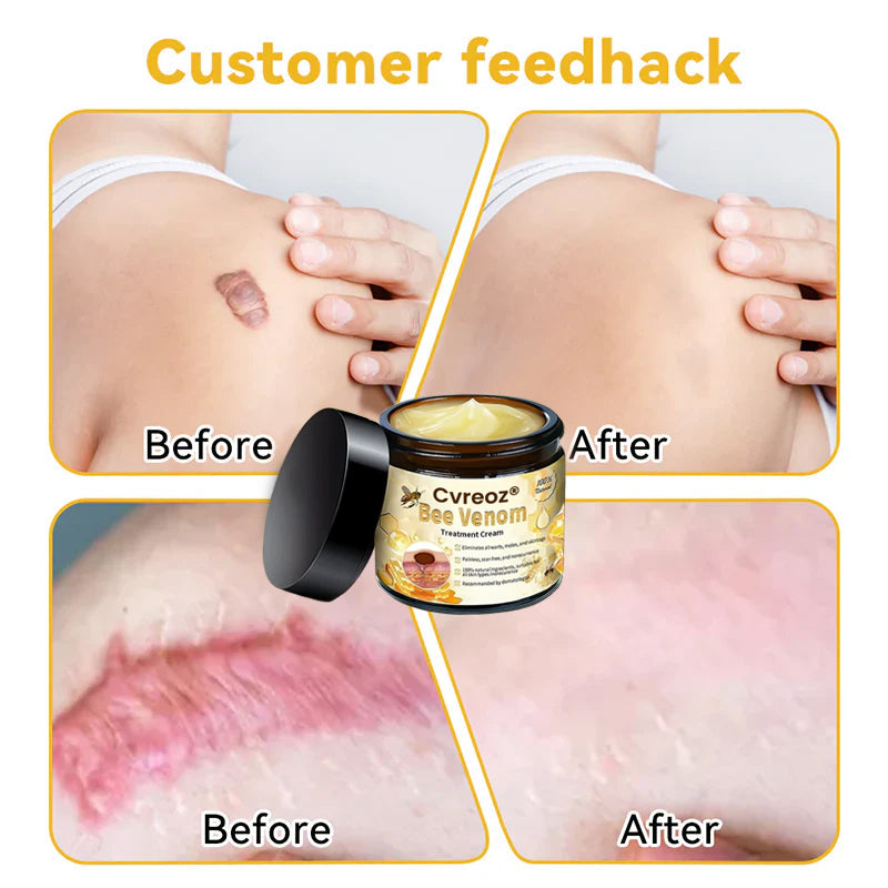 🔥FDA Approved⭐ WHO Approved🌍 Cvreoz® Bee Venom Skin Treatment Cream - Fast and effective⚡ targeting all skin issues✅ If ineffective, a refund is guaranteed💯