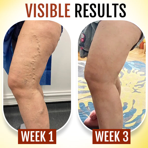 VliCare™ Varicose Veins Foot Patch