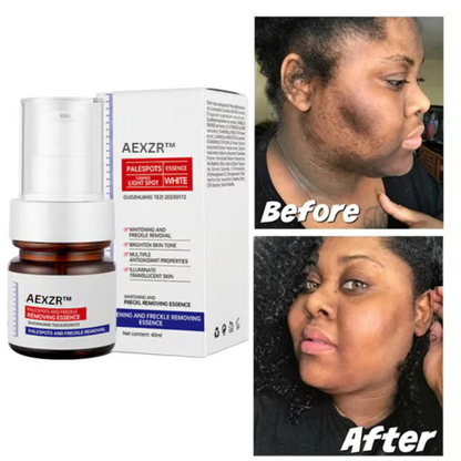 🔥 AEXZR™ Vitamin C Whitening Freckles Face Cream Remove Melasma Dark Spots Lighten Melanin