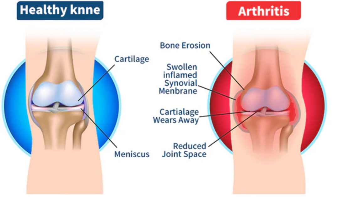 Beethera™ Bee Venom Advanced Joint and Bone Therapy Cream (New Zealand Bee Extract - Specializes in Orthopedic Diseases and Arthritis Pain)