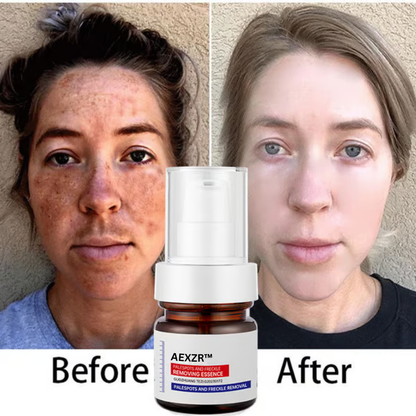 🔥 AEXZR™ Vitamin C Whitening Freckles Face Cream Remove Melasma Dark Spots Lighten Melanin