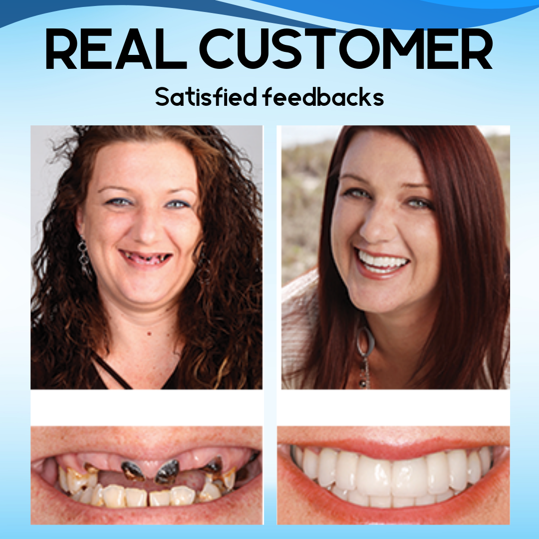 AEXZR™ SnapOn Silicone Veneers