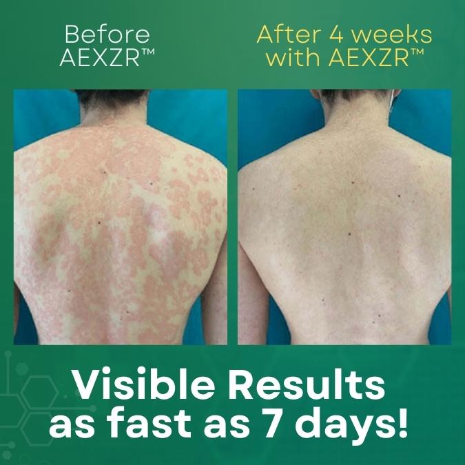 AEXZR™ Psoriasis Cream