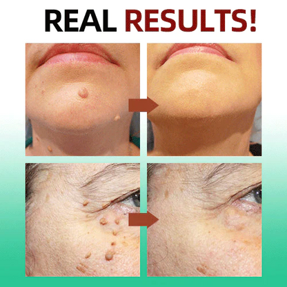 AEXZR™ Tags & Moles Remover