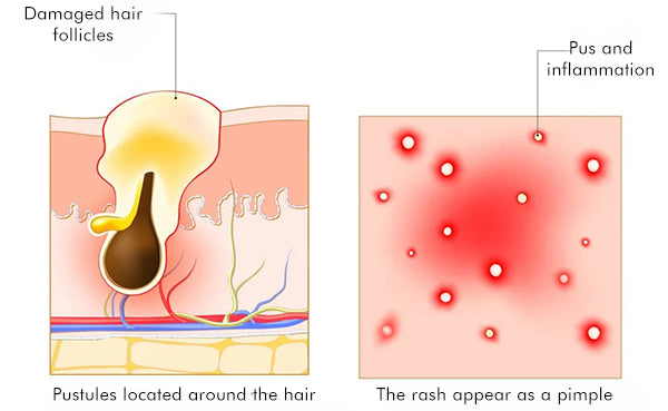 AEXZR™ Folliculitis Clearing Spray