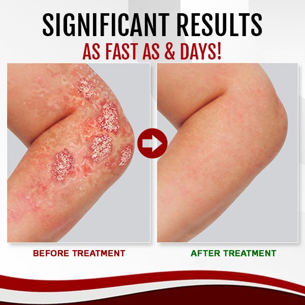 AEXZR™ Psoriasis Treatment Spray