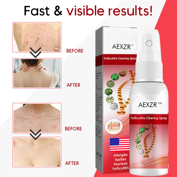 AEXZR™ Folliculitis Clearing Spray