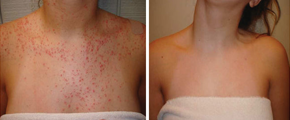 AEXZR™ Folliculitis Clearing Spray