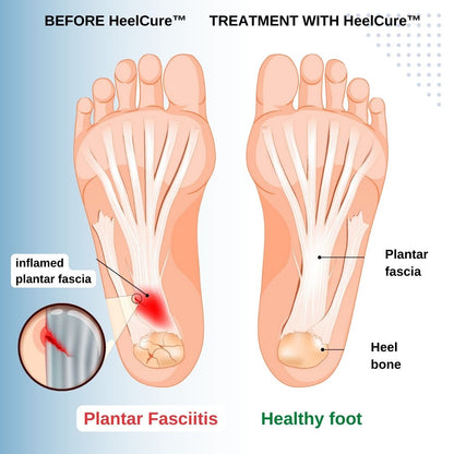 HeelCure™ Plantar Fasciitis Pain Relief Cream